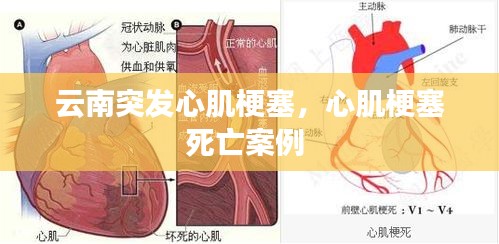 云南突發(fā)心肌梗塞，心肌梗塞死亡案例 