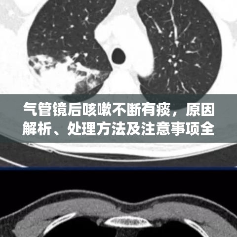 氣管鏡后咳嗽不斷有痰，原因解析、處理方法及注意事項(xiàng)全攻略