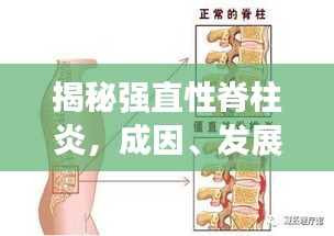 揭秘強(qiáng)直性脊柱炎，成因、發(fā)展與突發(fā)性的真相解析