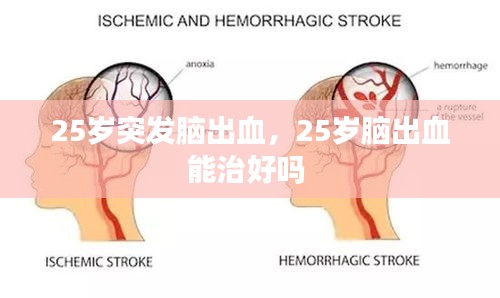 25歲突發(fā)腦出血，25歲腦出血能治好嗎 